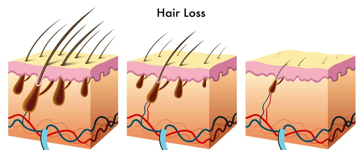 RU58841 for Hair Los